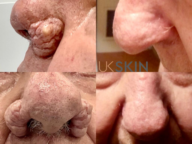 Skin Excess UK Skin