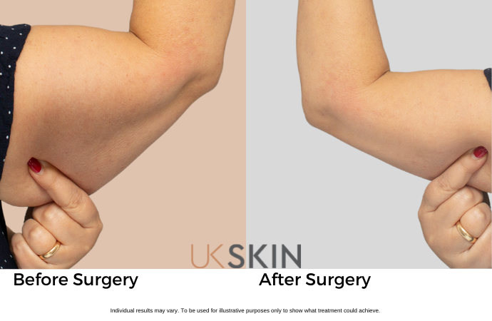Arm Lift (Brachioplasty) UK Skin