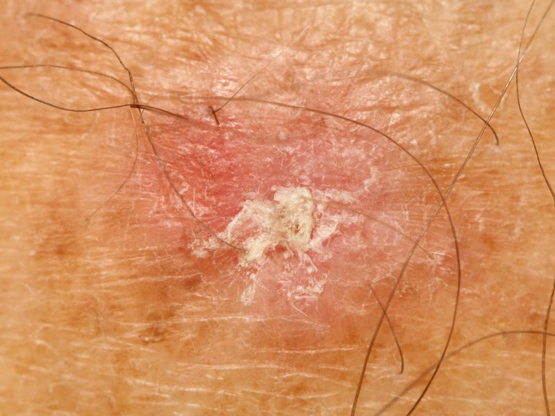 Benign Skin Lesions UK Skin