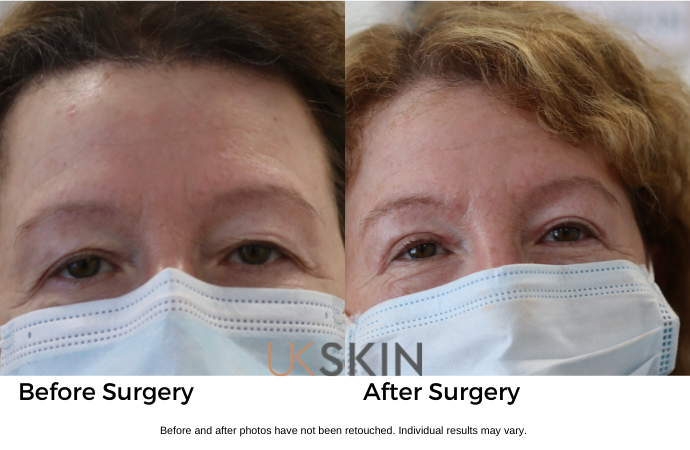 Eyelid Surgery (Blepharoplasty) UK Skin