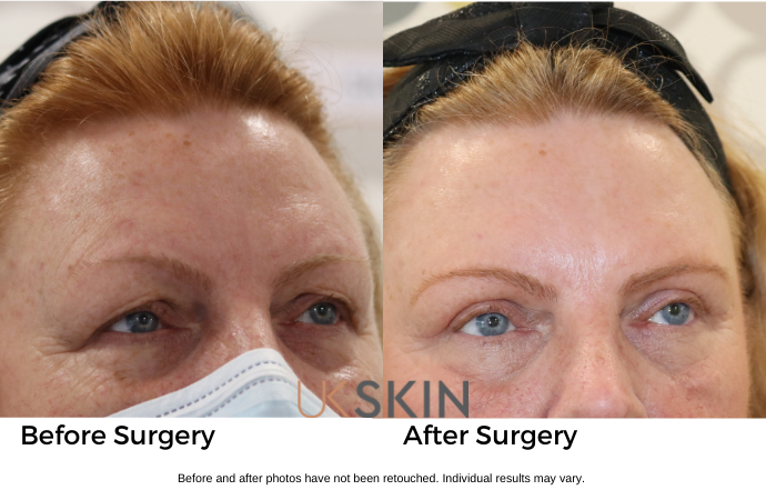 Eyelid Surgery (Blepharoplasty) UK Skin