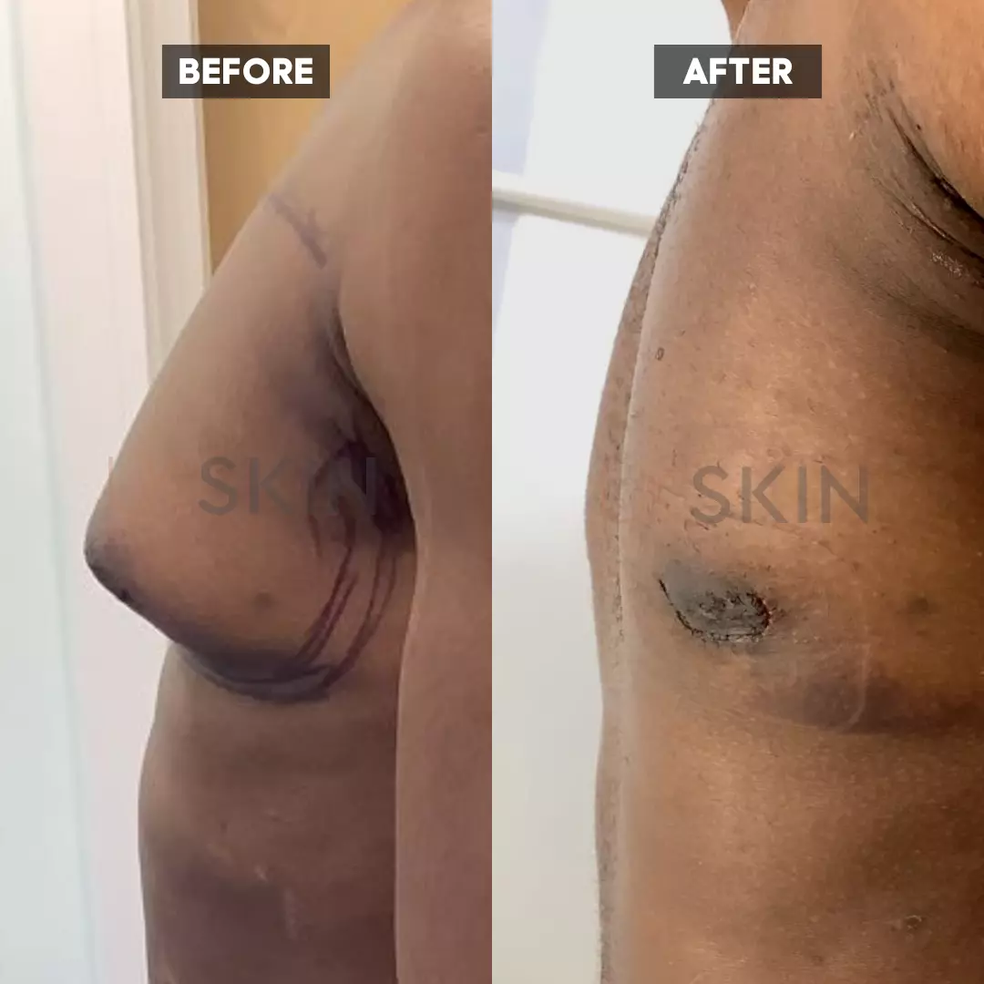 Male Chest Reduction - 001TPC-Side - The Private Clinic of Harley Street  London