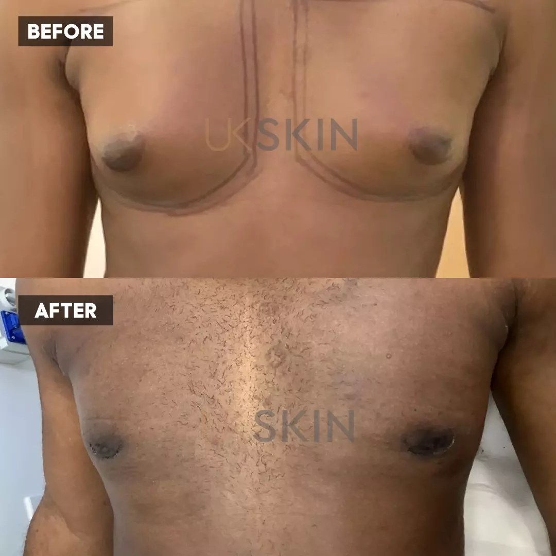 Male Chest Reduction - 001TPC-Side - The Private Clinic of Harley Street  London