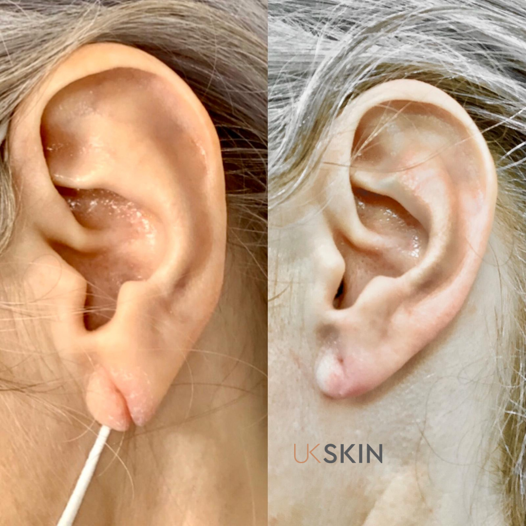 Your Split Earlobe Repair Questions Answered - Harley Clinic
