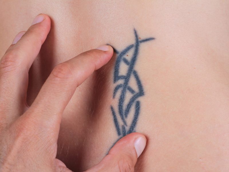 Private Tattoo Removal | Surgical Tattoo Removal | UKSKIN